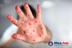 Корь: что нужно знать о болезни